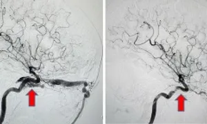 Lồi mắt, ù tai do rò mạch máu não